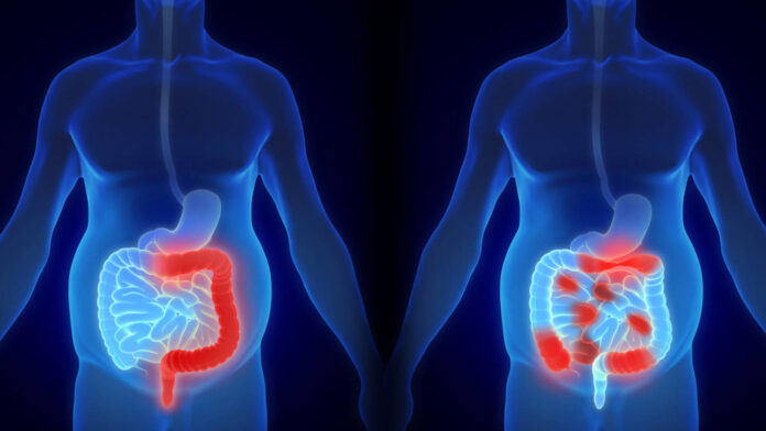 Enfermedad-inflamatoria-intestinal