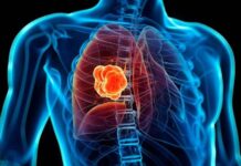 Un nuevo tratamiento aumenta la supervivencia en pacientes con cáncer de pulmón